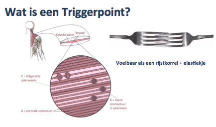 triggerpoint therapie