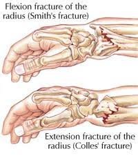 Radiuskopfractuur