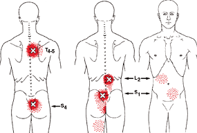 triggerpoints-erector-spinae