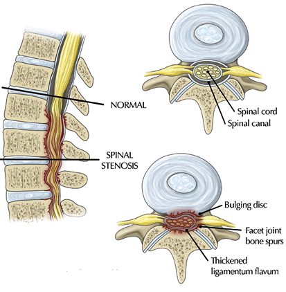 vernauwing spinaal kanaal lage rug