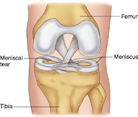 meniscus scheur
