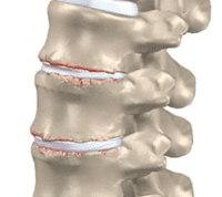 Artrose lage rug slijtage onderrug