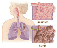 COPD-vaak-onopgemerkt.png