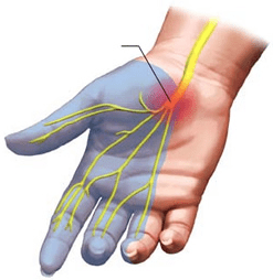 carpaal tunnel syndroom hand