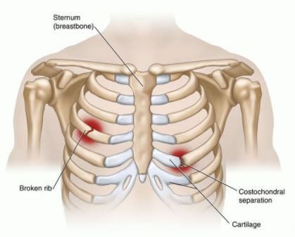 Costochondritis Oefeningen En Behandeling | Fysiotherapie4all