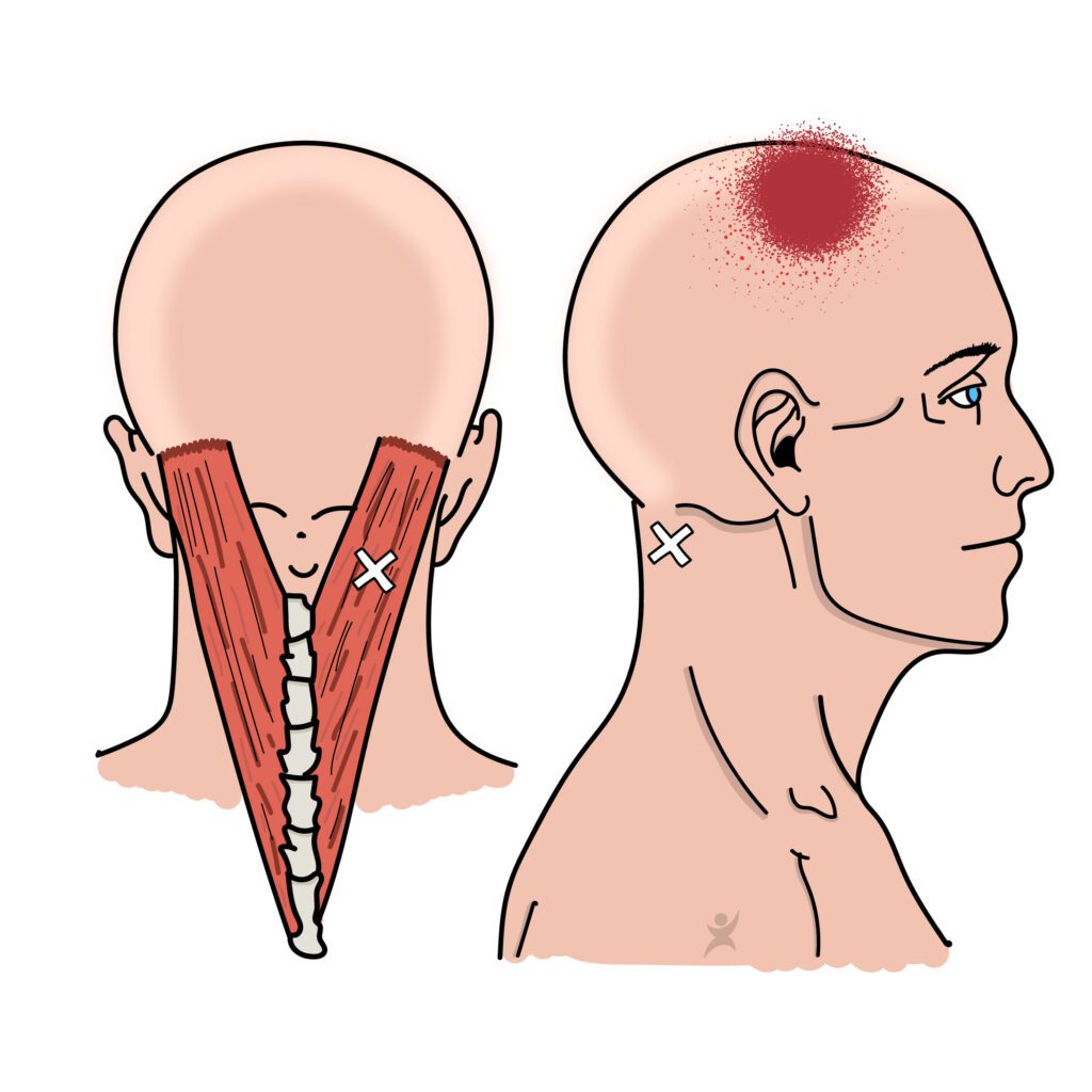 triggerpointtherapie bij hoofdpijnklachten