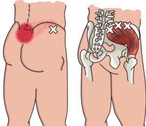 gluteus medius trigger point